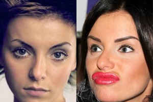 Не было печали – губы накачали: фото российских знаменитостей до и после коррекции губ