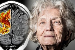 Простой анализ крови может выявить болезнь Альцгеймера за 16 лет до появления признаков
